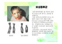묘성&윌리엄스 정의, 원인, 진단, 특성-15