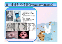 에드워드 파타우 PPT 정의, 원인-12