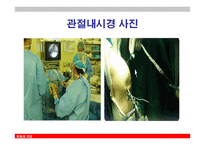 관절내시경을 이용한 반월상 연골절제술-5