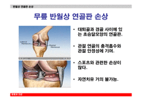 관절내시경을 이용한 반월상 연골절제술-7