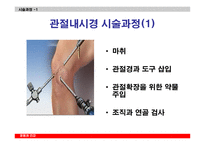 관절내시경을 이용한 반월상 연골절제술-10