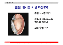 관절내시경을 이용한 반월상 연골절제술-12