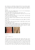 유아 건강과 안전에 대한 사례 수족구병-2