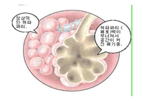 폐기종 Emphysema요약-3