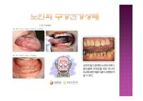 노인과 구강건조증-6