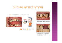 노인과 구강건조증-7