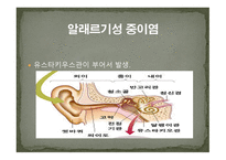 청각장애의 원인-7