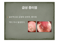 청각장애의 원인-8