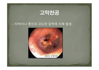 청각장애의 원인-10