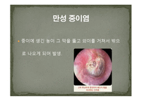 청각장애의 원인-12