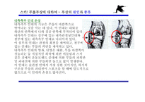 겨울 스포츠 스키와 무릎 부상-10