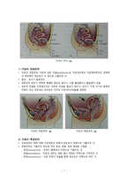 간호학 생식기의 구조이상 생식기 기형 성선 발육장애 자궁의 위치 이상-7