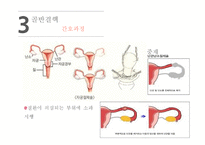 간호학 경관 염골반 염증성 질환 골반 결핵-12
