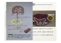 간호학 근위축성 측색 경화증 Amyotropiclateral sclerosis ALS-3