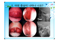 편도선 수술 레포트-3