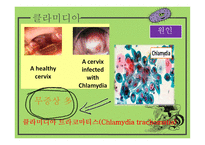 간호학 성전파성 감염-4
