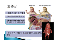간호학 고빌리루빈 혈증과 간호 용혈성 질환-9