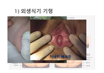 간호학 생식기 구조이상 생식기 기형 성선 발육장애 자궁의 위치 이상-4