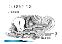 간호학 생식기 구조이상 생식기 기형 성선 발육장애 자궁의 위치 이상-6