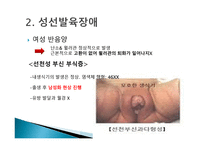 간호학 생식기 구조이상 생식기 기형 성선 발육장애 자궁의 위치 이상-9