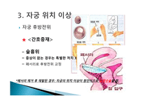 간호학 생식기 구조이상 생식기 기형 성선 발육장애 자궁의 위치 이상-12
