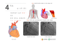 간호학 심근경색-12