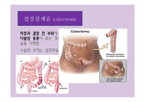간호학 결장직장암 치료와 간호-5