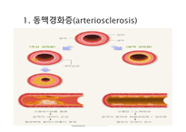 간호학 동맥경화증 급성 만성 동맥 폐색 대상자 간호-2