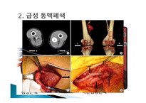 간호학 동맥경화증 급성 만성 동맥 폐색 대상자 간호-3